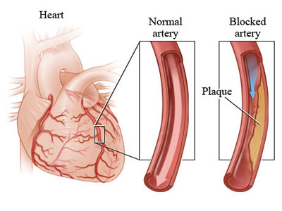 Coronary Artery Disease_intechopen.com